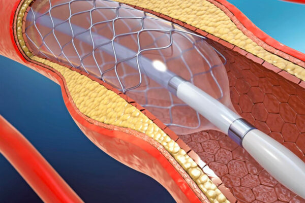 Anjiyoplasti (Stent) İşleminin Riskleri ve Komplikasyonları