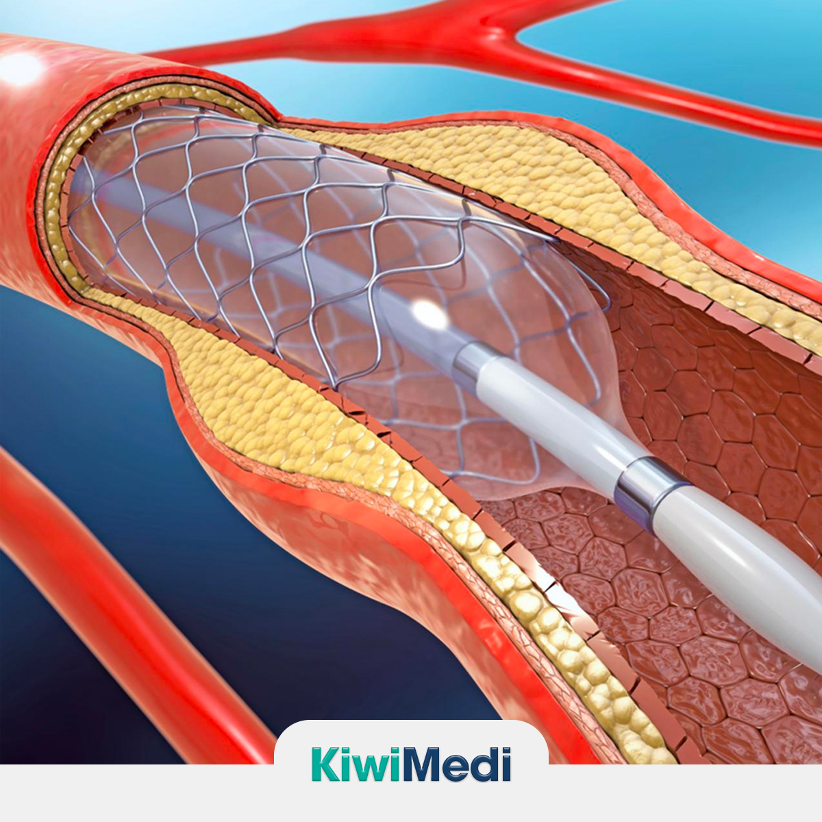 Anjiyoplasti (Stent) İşleminin Riskleri ve Komplikasyonları